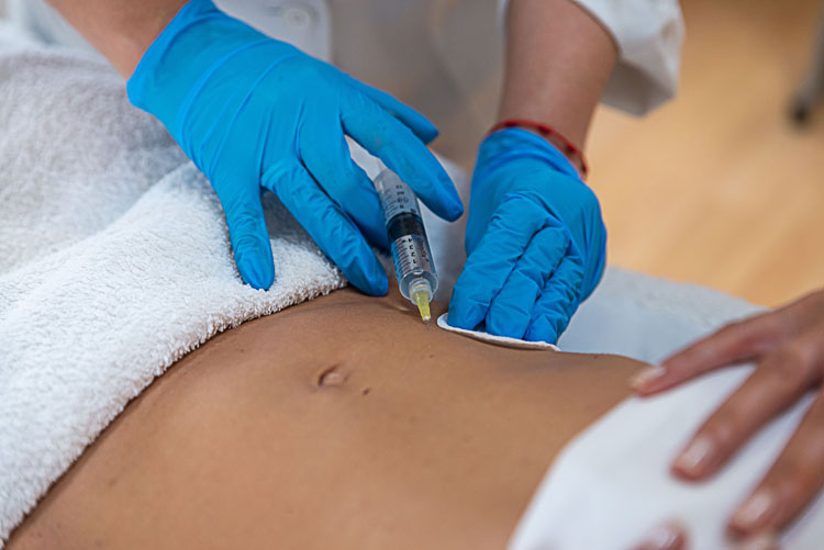 Tratamiento de mesoterapia en el abdomen de una mujer en Clínica Médico Estética Isabel Aragón