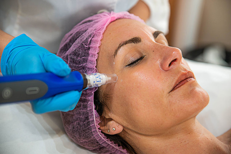 rostro de mujer recibiendo sesión de microneedling en Clínica Médico Estética Isabel Aragón