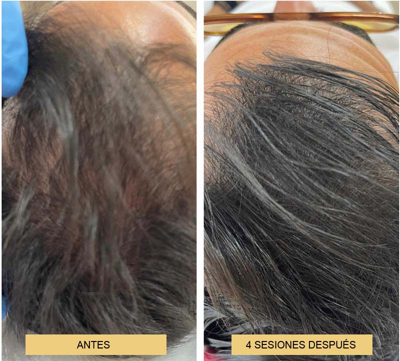 imagen de cabello antes y después del tratamiento de mesoterapia capilar